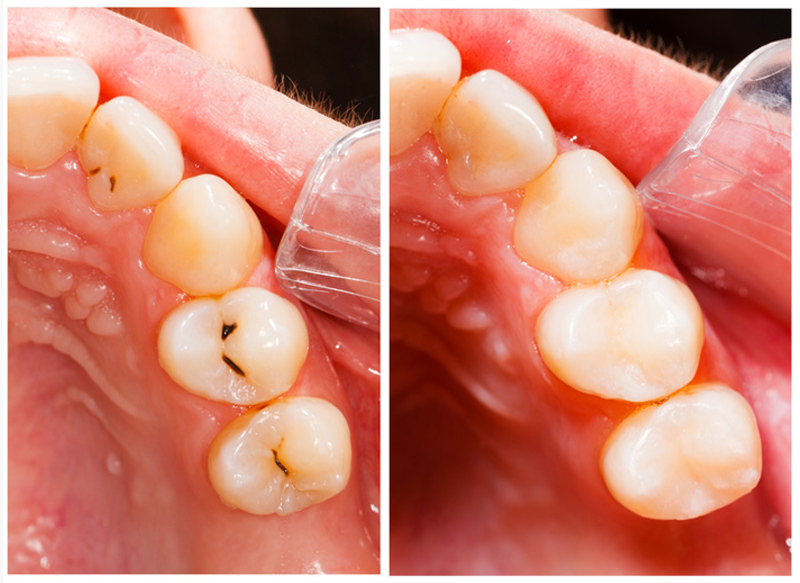 Tooth-colored fillings in Daly City, CA